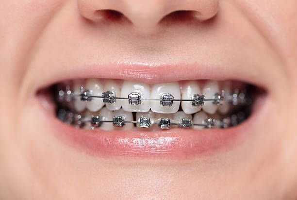 Everything You Need to Know About Fort Collins Braces Before Starting Treatment